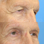 Source: Dr. Moubayed’s practice. Not a guarantee of results. Photos published with informed written consent of patients Male treated with endoscopic brow lift and upper blepharoplasty
