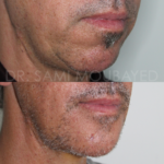 Source: Dr. Moubayed’s practice. Not a guarantee of results. Photos published with informed written consent of patients Male treated with silicone chin implant
