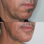 Source: Dr. Moubayed’s practice. Not a guarantee of results. Photos published with informed written consent of patients Male treated with silicone chin implant