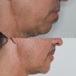 Source: Dr. Moubayed’s practice. Not a guarantee of results. Photos published with informed written consent of patients Male treated with silicone chin implant