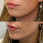 Source: Dr. Moubayed’s practice. Not a guarantee of results. Photos published with informed written consent of patients Female treated with silicone chin implant in Montreal