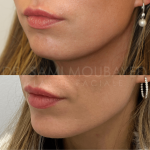 Source: Dr. Moubayed’s practice. Not a guarantee of results. Photos published with informed written consent of patients Female treated with silicone chin implant in Montreal