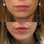Source: Dr. Moubayed’s practice. Not a guarantee of results. Photos published with informed written consent of patients Female treated with silicone chin implant in Montreal