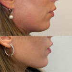 Source: Dr. Moubayed’s practice. Not a guarantee of results. Photos published with informed written consent of patients Female treated with silicone chin implant in Montreal