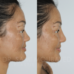 Source: Dr. Moubayed’s practice. Not a guarantee of results. Photos published with informed written consent of patients Female treated with ethnic augmentation rhinoplasty in Montreal