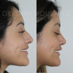 Source: Dr. Moubayed’s practice. Not a guarantee of results. Photos published with informed written consent of patients