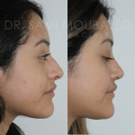 Source: Dr. Moubayed’s practice. Not a guarantee of results. Photos published with informed written consent of patients Female treated with ethnic septorhinoplasty in Montreal