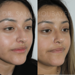 Source: Dr. Moubayed’s practice. Not a guarantee of results. Photos published with informed written consent of patients Female treated with ethnic septorhinoplasty in Montreal