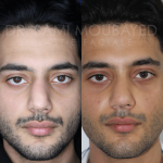 Source: Dr. Moubayed’s practice. Not a guarantee of results. Photos published with informed written consent of patients Male treated with ethnic septorhinoplasty in Montreal