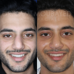 Source: Dr. Moubayed’s practice. Not a guarantee of results. Photos published with informed written consent of patients Male treated with ethnic septorhinoplasty in Montreal