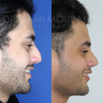 Source: Dr. Moubayed’s practice. Not a guarantee of results. Photos published with informed written consent of patients Male treated with ethnic septorhinoplasty in Montreal