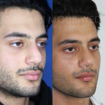 Source: Dr. Moubayed’s practice. Not a guarantee of results. Photos published with informed written consent of patients Male treated with ethnic septorhinoplasty in Montreal