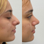 Source: Dr. Moubayed’s practice. Not a guarantee of results. Photos published with informed written consent of patients Female treated with ethnic septorhinoplasty in Montreal