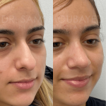 Source: Dr. Moubayed’s practice. Not a guarantee of results. Photos published with informed written consent of patients