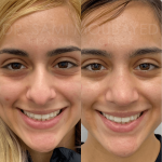 Source: Dr. Moubayed’s practice. Not a guarantee of results. Photos published with informed written consent of patients Female treated with ethnic septorhinoplasty in Montreal