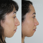 Source: Dr. Moubayed’s practice. Not a guarantee of results. Photos published with informed written consent of patients Female treated with ethnic septorhinoplasty in Montreal