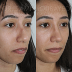 Source: Dr. Moubayed’s practice. Not a guarantee of results. Photos published with informed written consent of patients Female treated with ethnic septorhinoplasty in Montreal