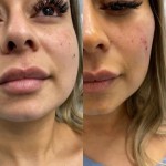 Source: Dr. Moubayed’s practice. Not a guarantee of results. Photos published with informed written consent of patients Female treated with buccal fat removal and fat transfer to face