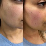 Source: Dr. Moubayed’s practice. Not a guarantee of results. Photos published with informed written consent of patients Female treated with buccal fat removal and fat transfer to face