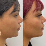 Source: Dr. Moubayed’s practice. Not a guarantee of results. Photos published with informed written consent of patients Female treated with fat transfer to face