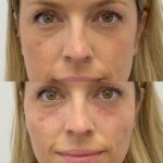 Source: Dr. Moubayed’s practice. Not a guarantee of results. Photos published with informed written consent of patients Female treated with dermal fillers for cheek and tear trough augmentation