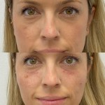 Source: Dr. Moubayed’s practice. Not a guarantee of results. Photos published with informed written consent of patients Female treated with dermal fillers for cheek and tear trough augmentation