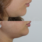 Source: Dr. Moubayed’s practice. Not a guarantee of results. Photos published with informed written consent of patients Female treated with dermal fillers for chin augmentation