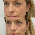 Source: Dr. Moubayed’s practice. Not a guarantee of results. Photos published with informed written consent of patients Female treated with dermal fillers for cheek and tear trough augmentation
