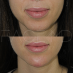 Source: Dr. Moubayed’s practice. Not a guarantee of results. Photos published with informed written consent of patients Female treated with dermal fillers to chin