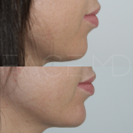 Source: Dr. Moubayed’s practice. Not a guarantee of results. Photos published with informed written consent of patients Female treated with dermal fillers to chin