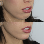 Source: Dr. Moubayed’s practice. Not a guarantee of results. Photos published with informed written consent of patients Female treated with dermal fillers to chin