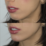 Source: Dr. Moubayed’s practice. Not a guarantee of results. Photos published with informed written consent of patients Female treated with dermal fillers to chin
