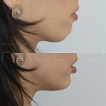 Source: Dr. Moubayed’s practice. Not a guarantee of results. Photos published with informed written consent of patients Female treated with dermal fillers to chin