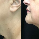 Source: Dr. Moubayed’s practice. Not a guarantee of results. Photos published with informed written consent of patients