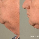 Source: Dr. Moubayed’s practice. Not a guarantee of results. Photos published with informed written consent of patients Male treated with FaceTite