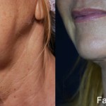 Source: Dr. Moubayed’s practice. Not a guarantee of results. Photos published with informed written consent of patients Female treated with FaceTite