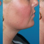 Source: Dr. Moubayed’s practice. Not a guarantee of results. Photos published with informed written consent of patients Female treated with FaceTite