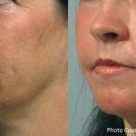 Source: Dr. Moubayed’s practice. Not a guarantee of results. Photos published with informed written consent of patients Female treated with FaceTite