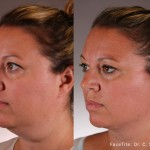 Source: Dr. Moubayed’s practice. Not a guarantee of results. Photos published with informed written consent of patients Female treated with FaceTite