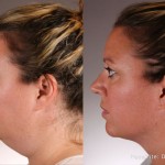 Source: Dr. Moubayed’s practice. Not a guarantee of results. Photos published with informed written consent of patients