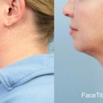 Source: Dr. Moubayed’s practice. Not a guarantee of results. Photos published with informed written consent of patients Female treated with FaceTite