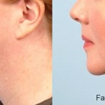 Source: Dr. Moubayed’s practice. Not a guarantee of results. Photos published with informed written consent of patients Female treated with FaceTite
