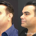 Source: Dr. Moubayed’s practice. Not a guarantee of results. Photos published with informed written consent of patients Male treated with FaceTite