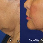 Source: Dr. Moubayed’s practice. Not a guarantee of results. Photos published with informed written consent of patients Female treated with FaceTite