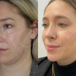 Source: Dr. Moubayed’s practice. Not a guarantee of results. Photos published with informed written consent of patients Female treated with FaceTite and liposuction
