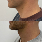 Source: Dr. Moubayed’s practice. Not a guarantee of results. Photos published with informed written consent of patients Male treated with deep neck lift in Montreal