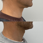Source: Dr. Moubayed’s practice. Not a guarantee of results. Photos published with informed written consent of patients Male treated with deep neck lift in Montreal