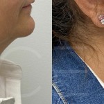 Source: Dr. Moubayed’s practice. Not a guarantee of results. Photos published with informed written consent of patients Female treated with deep neck lift and facelift in Montreal