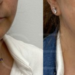 Source: Dr. Moubayed’s practice. Not a guarantee of results. Photos published with informed written consent of patients Female treated with deep neck lift and facelift in Montreal