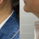 Source: Dr. Moubayed’s practice. Not a guarantee of results. Photos published with informed written consent of patients Female treated with deep neck lift and facelift in Montreal